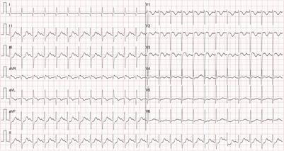An Atypical Anomalous Aortic Origin of the Left Coronary Artery With Intra-Arterial Wall Course Pretending a Normal Migration on Imaging Screening: A Case Report
